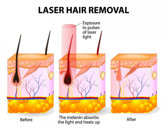 Portable Laser Hair Removal Professional Equipment 808nm Wavelength 62.5 * 60 * 116CM